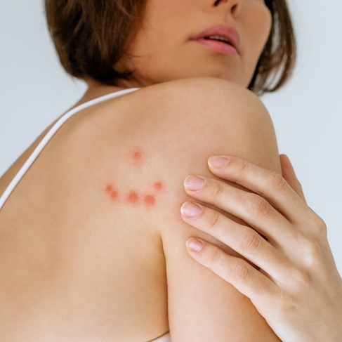 The Dangers of Bed Bugs